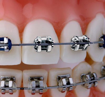 Niềng răng mắc cài tự buộc